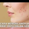 Mengatasi Jerawat Batu: Panduan Lengkap untuk Kulit Sehat dan Bebas Percaya Diri