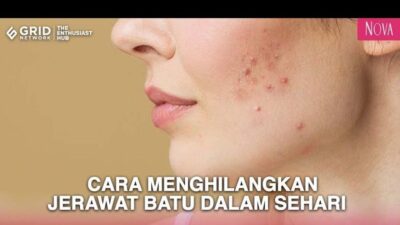 Mengatasi Jerawat Batu: Panduan Lengkap untuk Kulit Sehat dan Bebas Percaya Diri